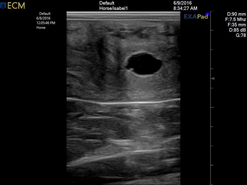 13-cyst in uterus