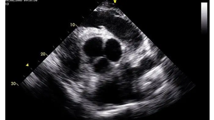 Image of a normal aortic valve in a horse using power doppler. Image taken on GE LOGIC e 3S-RS